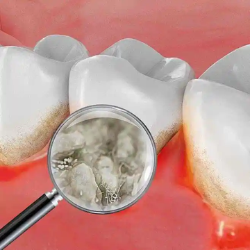 Remove plaque